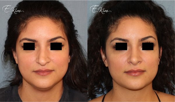 Rhinoplasty - The nose is the central feature of the face and can have a significant impact on your physical appearance. If you are unhappy with the appearance of your nose, you may benefit from rhinoplasty. Rhinoplasty can improve the shape and size of your nose to help you look and feel your best. Rhinoplasty - The nose is the central feature of the face and can have a significant impact on your physical appearance. If you are unhappy with the appearance of your nose, you may benefit from rhinoplasty. Rhinoplasty can improve the shape and size of your nose to help you look and feel your best.