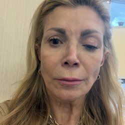 Ecobel Med Spa - Botox injection that caused a droopy eyelid (ptosis). Caused bythe injection going to deep or in the wrong location.