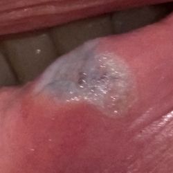 Prominent Point Dental Group and Orthodontics - My cut lip