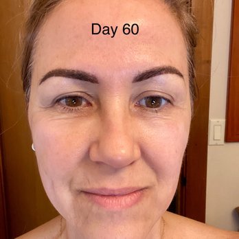 Spa Blue - 60 days later no make up - Medical Spas Near Me - Orlando, Florida Spa Blue - 60 days later no make up - Medical Spas Near Me - Orlando, Florida