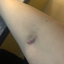 Laboratorio Médico Polanco - Así luce mi brazo