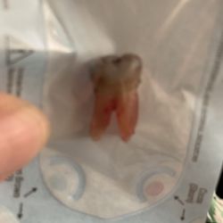 Woodland Family Dental - This is my abscessed molar that was removed painlessly an hour ago. Thanks to Woodland Dental, my mouth feels a whole lot better now!