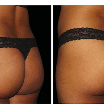 Aesthetic Solutions - Emsculpt to lift and tone the buttocks - Dermatologists Near Me - Chapel Hill, North Carolina
