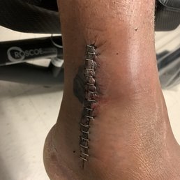 Before sutures were removed, after surgery.