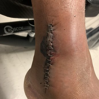 ANTEBI ALON D.O. - Before sutures were removed, after surgery. - Sports Medicine Near Me - Lancaster, California