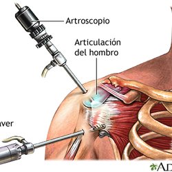 Dr Arceo Traumatologo Ortopedista Tijuana - Artroscopia de hombro