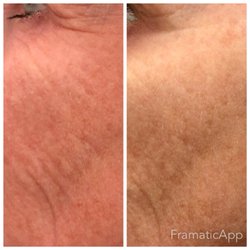 Revitalize A Skin Studio - After two Timeless peels performed by our practice. Client was very happy