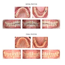 T. Scott Jenkins, DDS - Adult with skeletal openbite treated without extractions and without surgery.