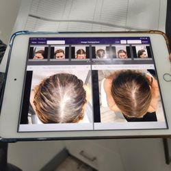 Dermatologist Los Angeles - Ben Behnam, MD, FAAD - After just 1 laser hair growth treatment!
