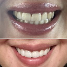 Before above, after below (fixed midline, top teeth completely redone)