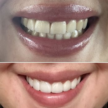 Summy Abbassi, DDS - Before above, after below (fixed midline, top teeth completely redone) - Cosmetic Dentists Near Me - Tarzana, California