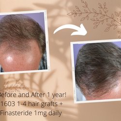 Nicole Rogers, MD, FAAD - Hair Restoration of the South - Before and after hair transplantation (FUT) with Dr. Nicole Rogers
