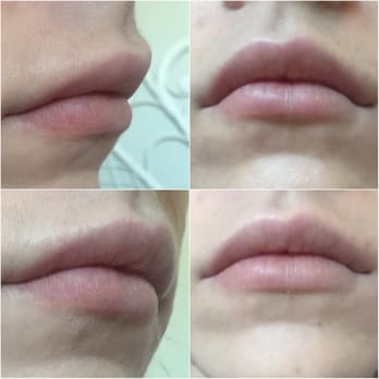 Devine Image - 2 weeks after juvederm. Same day, just different angles. Please note: one side was taller already, not from injections - Medical Spas Near Me - Tustin, California Devine Image - 2 weeks after juvederm. Same day, just different angles. Please note: one side was taller already, not from injections - Medical Spas Near Me - Tustin, California