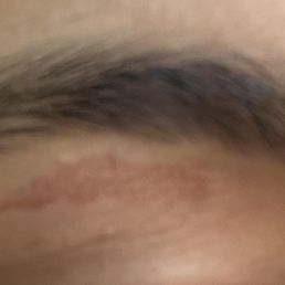 eyebrow wax was too hot and left a burn on my skin eyebrow wax was too hot and left a burn on my skin