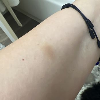 Burke Williams Day Spa - A couple days later.. bruise is finally going away - Day Spas Near Me - Pasadena, California Burke Williams Day Spa - A couple days later.. bruise is finally going away - Day Spas Near Me - Pasadena, California