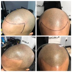 Scalp New England
