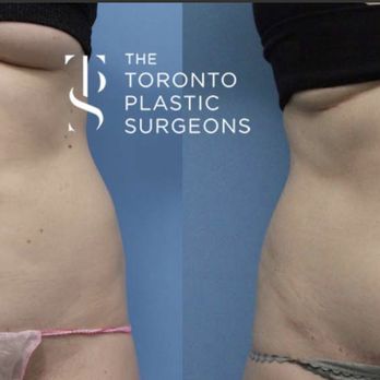 SpaMedica - Here i am standing up
The scar should have been attached to the horizontal line.
And there is still a lot of extra skin and fat up top - Medical Spas Near Me - Toronto, Ontario SpaMedica - Here i am standing up
The scar should have been attached to the horizontal line.
And there is still a lot of extra skin and fat up top - Medical Spas Near Me - Toronto, Ontario