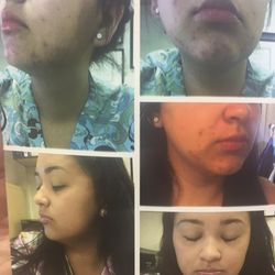 New Image Laser - Acne, hair removal and scar treatment .
