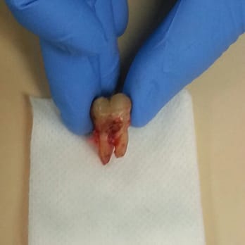 Charlotte Emergency Dental - The pain in my mouth that was removed. - General Dentistry Near Me - Charlotte, North Carolina Charlotte Emergency Dental - The pain in my mouth that was removed. - General Dentistry Near Me - Charlotte, North Carolina
