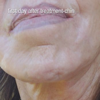 Revive Aesthetics - My chin is much worse--how could that happen? - Medical Spas Near Me - Fairbanks, Alaska