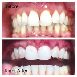 Chad Shaw, DDS - Here is the before and after of a PST