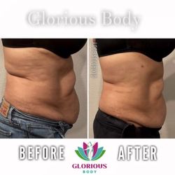 Glorious Body Sculpt - Cavitation Combo & Muscle Toning Therapy