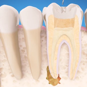 Radix Endodontics - Root Canal Specialists is Upland CA. We have a gentle and caring approach and will handle things smoothly for you. - Endodontists Near Me - Upland, California Radix Endodontics - Root Canal Specialists is Upland CA. We have a gentle and caring approach and will handle things smoothly for you. - Endodontists Near Me - Upland, California