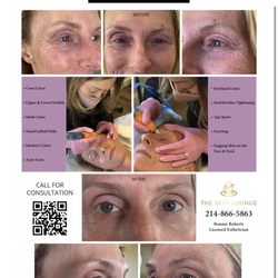 The Skin Lounge - Plasma pen before and after