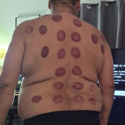 Cupping with Massage.