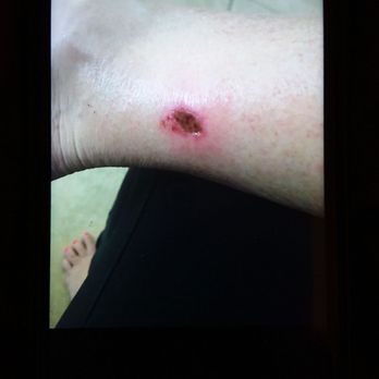 Bella Nails - Burn from a pedicure - Nail Salons Near Me - La Quinta, California Bella Nails - Burn from a pedicure - Nail Salons Near Me - La Quinta, California