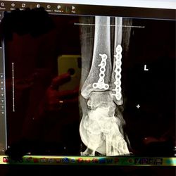 Bryan Aduddell, MD - Comprehensive Pain Solutions of Texas - After first surgery