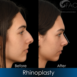 FAC Centers for Aesthetic Medicine - Rhinoplasty Dr. Brandon