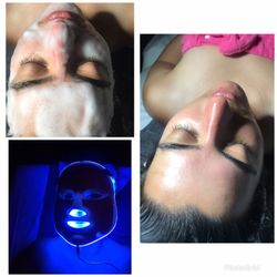 Ang Esthetics - Champagne facial, with LED blue light therapy!