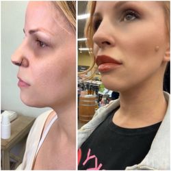 Becky Does Botox - Absolutely no work vs Becky's magic with cheeks, jawline, chin and lips