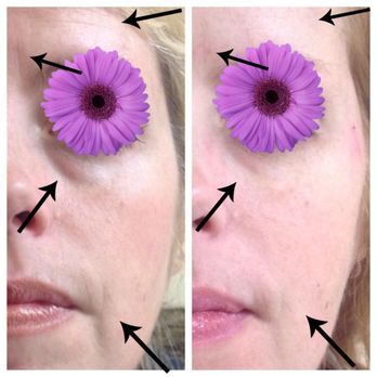 Victory Medical Spa - Beginning signs of volume loss on this younger patient. Dermal fillers restore her youthfulness. - Medical Spas Near Me - Cranston, Rhode Island Victory Medical Spa - Beginning signs of volume loss on this younger patient. Dermal fillers restore her youthfulness. - Medical Spas Near Me - Cranston, Rhode Island