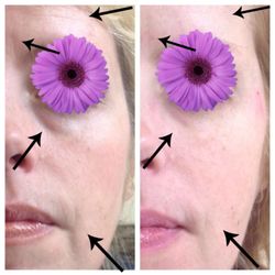 Beginning signs of volume loss on this younger patient. Dermal fillers restore her youthfulness.
