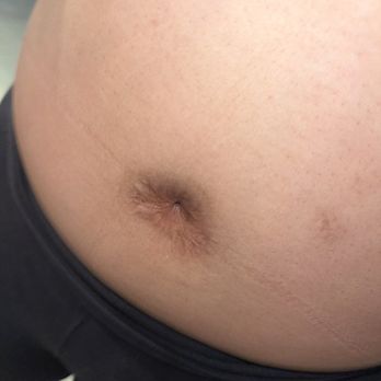 Professional Plastic Surgery - Her closed belly - Cosmetic Surgeons Near Me - Miami, Florida