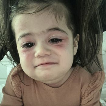 Mosaic Integrative Medicine - March 26, 2023 - after using steroid cream that our pediatrician deemed safe around her eyes. - Naturopathic/Holistic Near Me - San Diego, California