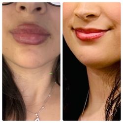 Manasra Medical Spa - You can definitely see a difference! I love them!!