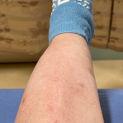 Marian Regional Medical Center - This is a picture of my calf! I was diagnosed with EDEMA at Arroyo Grande ER 2 days before and they did nothing.