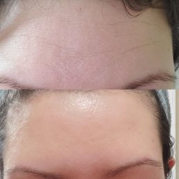 Before/8 days after botox treatment Before/8 days after botox treatment