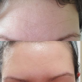Tacoma Laser Clinic - Before/8 days after botox treatment - Medical Spas Near Me - Tacoma, Washington Tacoma Laser Clinic - Before/8 days after botox treatment - Medical Spas Near Me - Tacoma, Washington