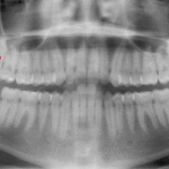 Ana R Ortiz, DDS - Wisdom Teeth Extractions - Oral Surgeons Near Me Ana R Ortiz, DDS - Wisdom Teeth Extractions - Oral Surgeons Near Me