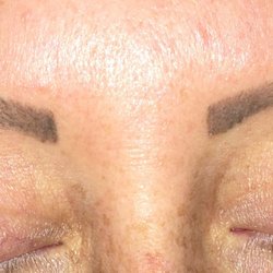 Gahanna Cosmetic Therapy & Skin Care Center - Current day; after 5 months.