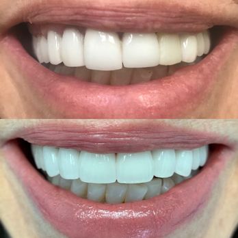 Riverdale Comprehensive Dentistry - Front teeth porcelain crowns and implant. Before and after. - Pediatric Dentists Near Me - bronx, New York