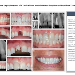 Drs, Chang and Tatum, Periodontics & Implant Center Of McKinney - Same Day Tooth Replacement with a Dental Implant - By Dr. Paul Chang DDS MS