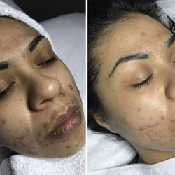 Blooming Beauty Salon & Spa - Treatment Facials. Two months in and her skin look even better now, check out my instagram for the most recent progress.