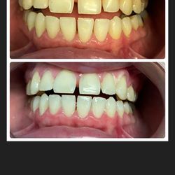 Great White Smiles - I was MORTIFIED seeing my before!! Thankfully Great White Smiles gave me a white smile!