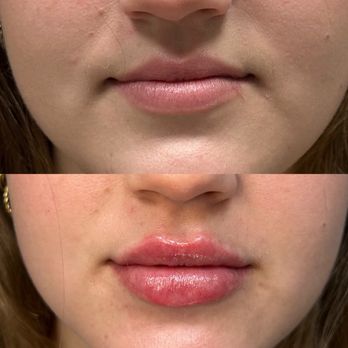 All About Aesthetics Med Spa - Lip filler before and after - Medical Spas Near Me - Boca Raton, Florida All About Aesthetics Med Spa - Lip filler before and after - Medical Spas Near Me - Boca Raton, Florida
