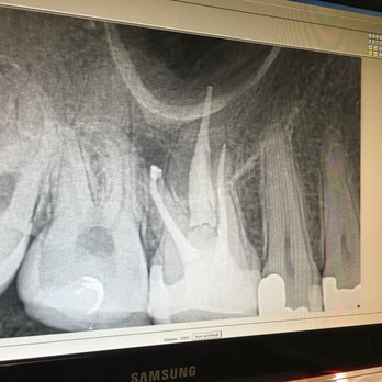 Pasadena Endodontix - Successful Root Canal - Endodontists Near Me - Pasadena, California